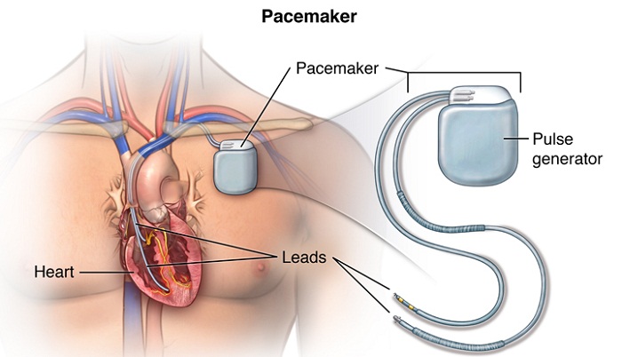 Record-breaking battery life for pacemaker technology